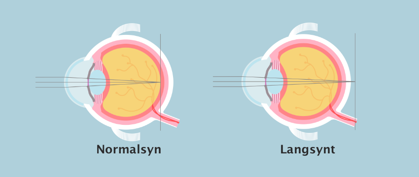Illustrasjon som viser normalsynt øye og langsynt øye